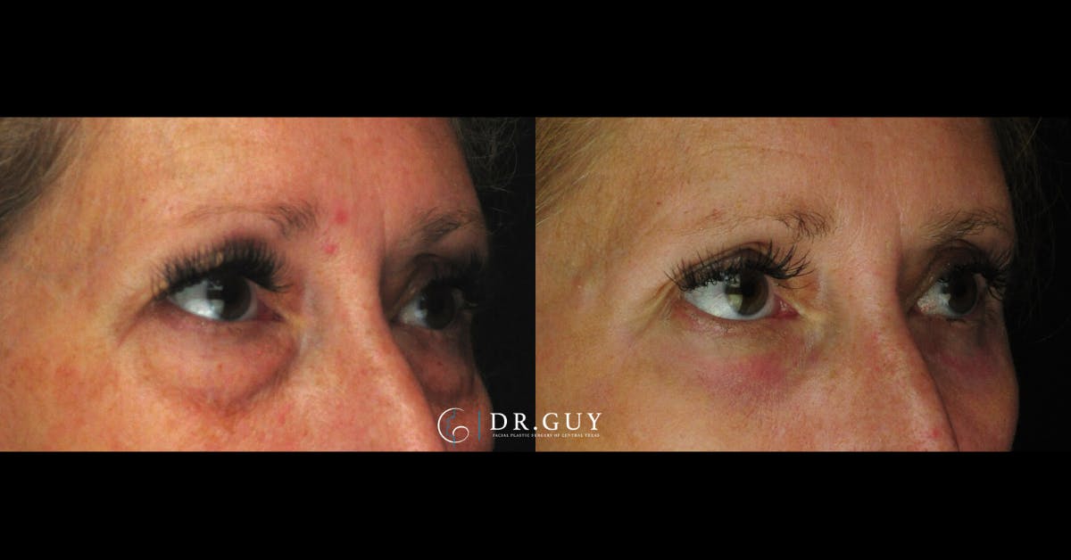 Lower Blepharoplasty Before & After Gallery - Patient 419512 - Image 4