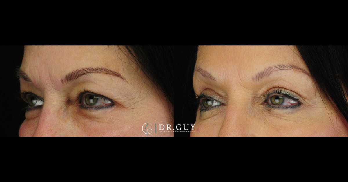 Upper Blepharoplasty Before & After Gallery - Patient 219944 - Image 2