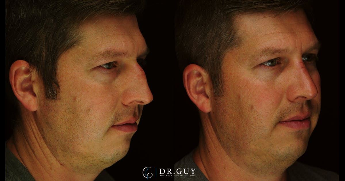 Surgical Rhinoplasty Before & After Gallery - Patient 179347 - Image 3