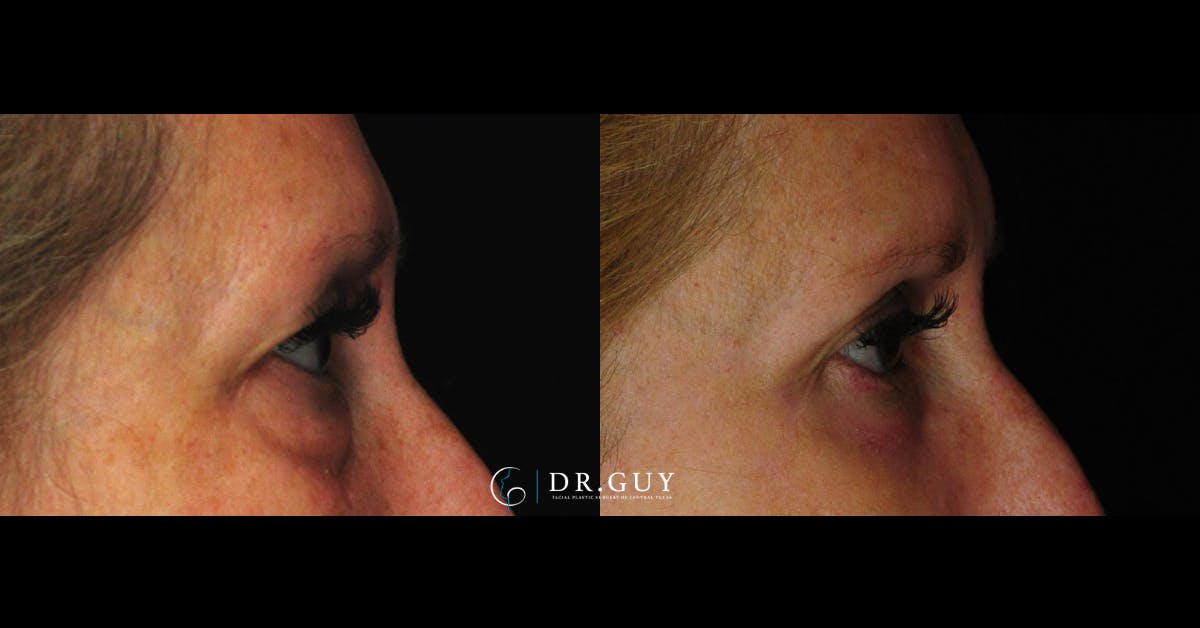 Lower Blepharoplasty Before & After Gallery - Patient 419512 - Image 5
