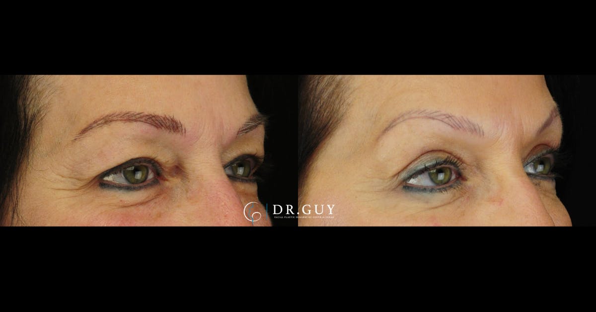 Upper Blepharoplasty Before & After Gallery - Patient 219944 - Image 3