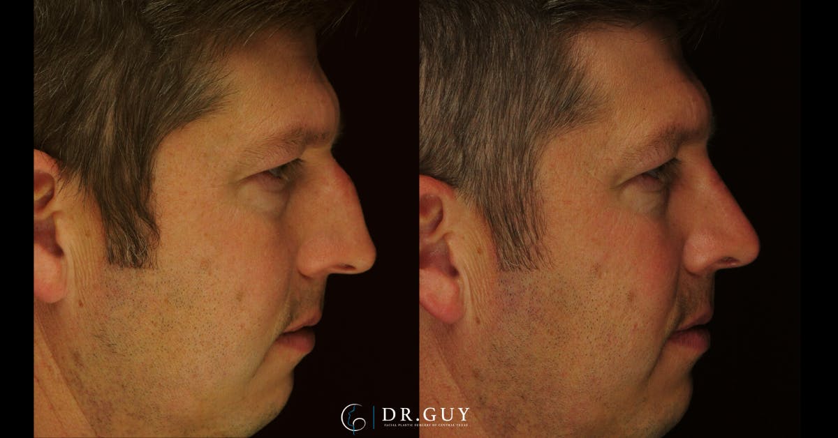 Surgical Rhinoplasty Before & After Gallery - Patient 179347 - Image 4