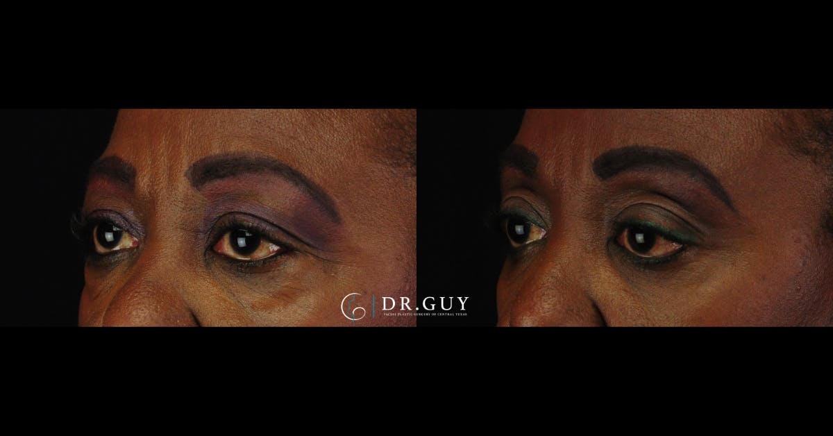 Lower Blepharoplasty Before & After Gallery - Patient 192802 - Image 1