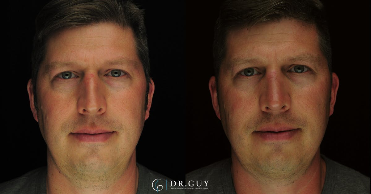 Surgical Rhinoplasty Before & After Gallery - Patient 179347 - Image 5