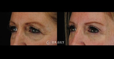 Upper Blepharoplasty Before & After Gallery - Patient 880632 - Image 1