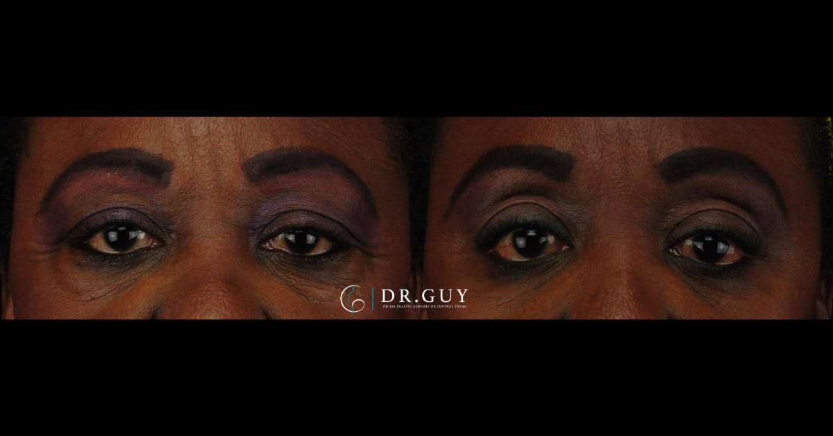 Lower Blepharoplasty Before & After Gallery - Patient 192802 - Image 2