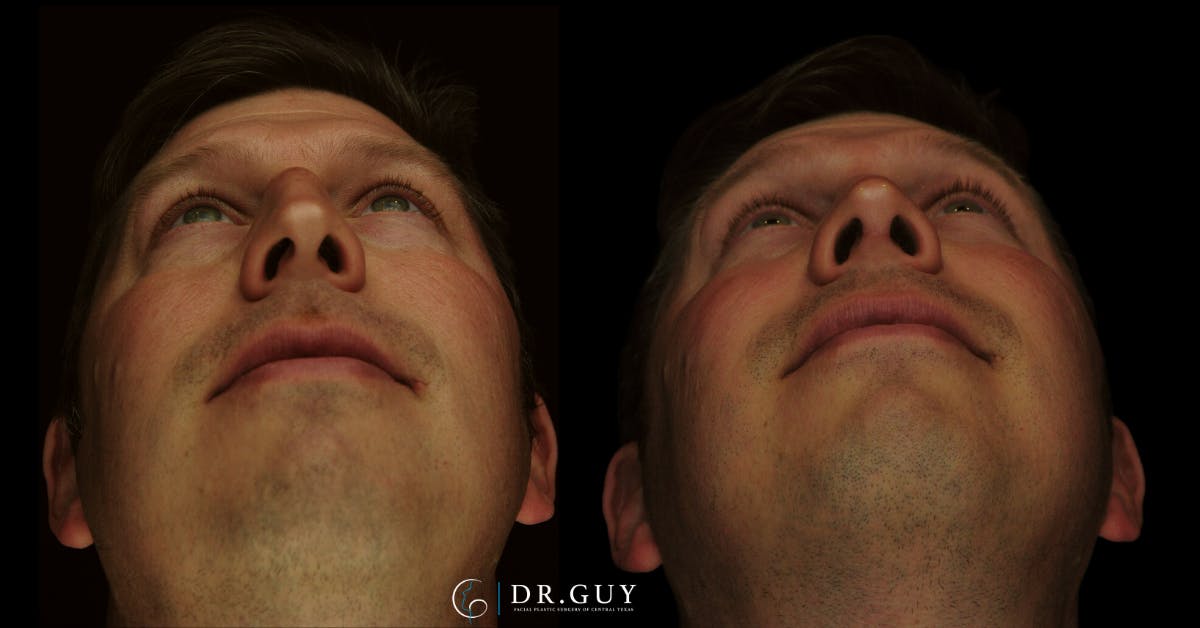 Surgical Rhinoplasty Before & After Gallery - Patient 179347 - Image 6