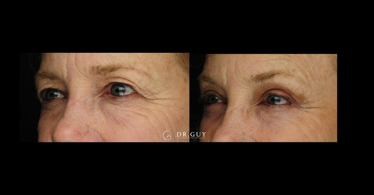 Browlift Before & After Gallery - Patient 185601 - Image 1