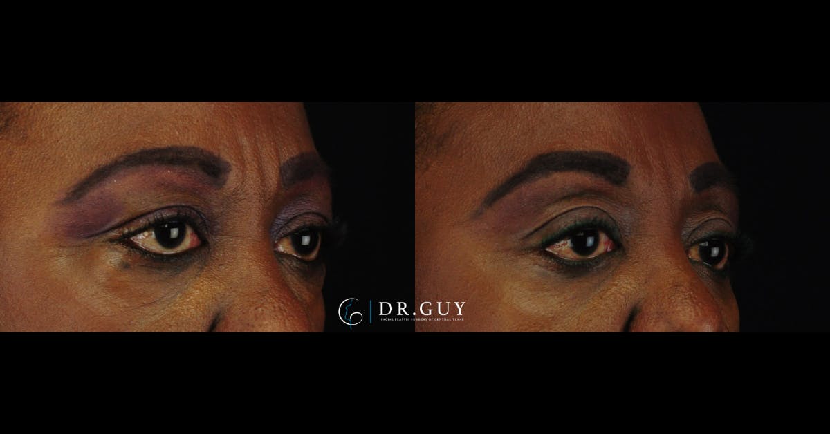 Lower Blepharoplasty Before & After Gallery - Patient 192802 - Image 3