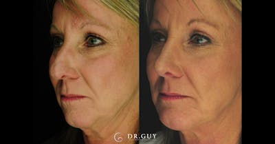 Surgical Rhinoplasty Before & After Gallery - Patient 298745 - Image 1