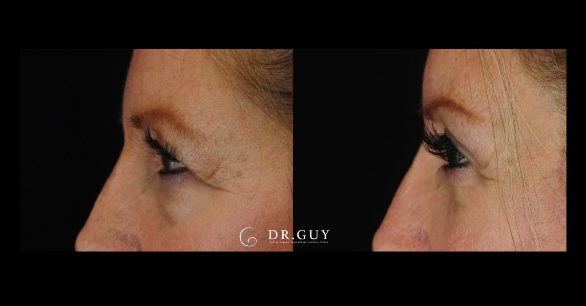 Upper Blepharoplasty Before & After Gallery - Patient 880632 - Image 4