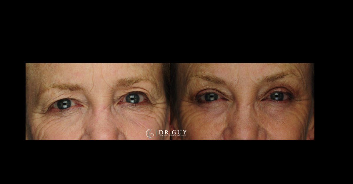 Browlift Before & After Gallery - Patient 185601 - Image 3