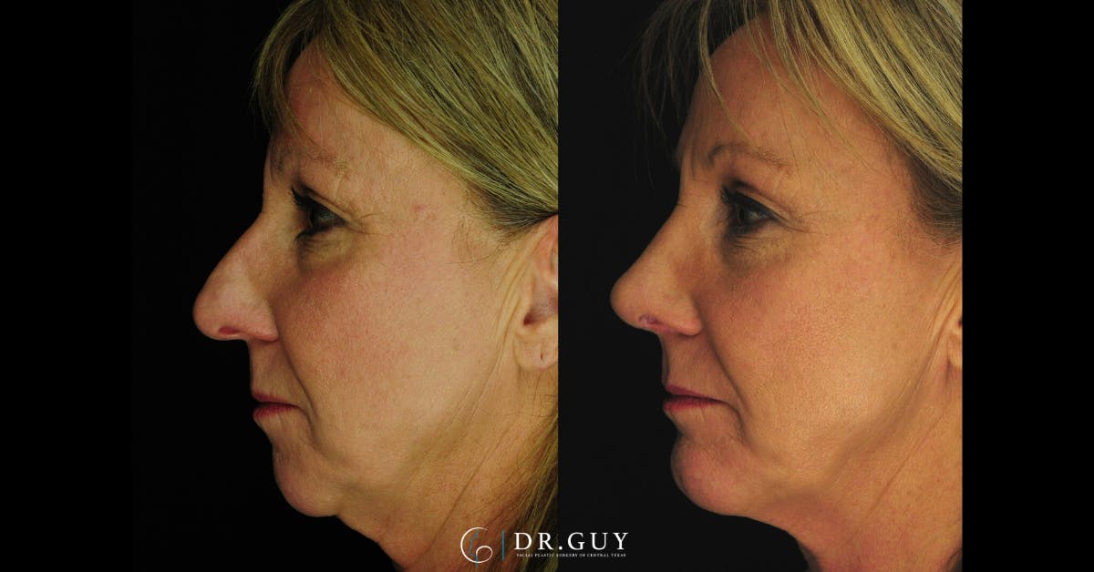 Surgical Rhinoplasty Before & After Gallery - Patient 298745 - Image 3