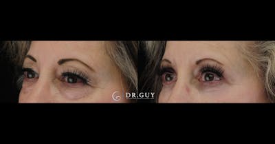 Upper Blepharoplasty Before & After Gallery - Patient 246240 - Image 1