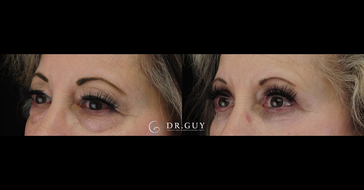 Upper Blepharoplasty Before & After Gallery - Patient 246240 - Image 1