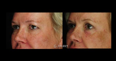 Browlift Before & After Gallery - Patient 755932 - Image 1