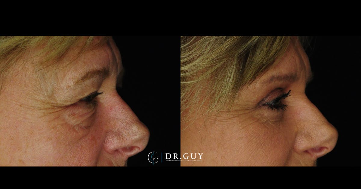 Lower Blepharoplasty Before & After Gallery - Patient 386958 - Image 5
