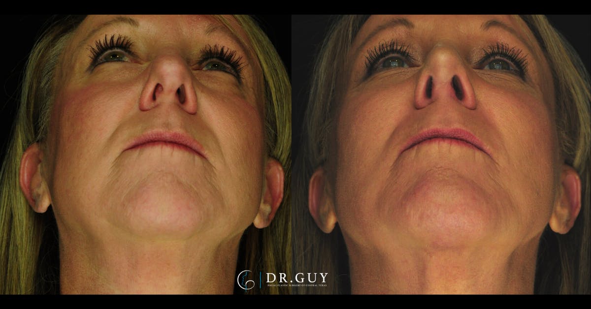 Surgical Rhinoplasty Before & After Gallery - Patient 298745 - Image 6