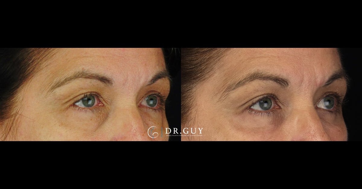 Lower Blepharoplasty Before & After Gallery - Patient 118617 - Image 1