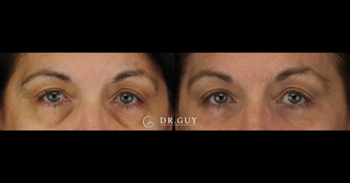 Lower Blepharoplasty Before & After Gallery - Patient 118617 - Image 2