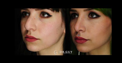 Surgical Rhinoplasty Before & After Gallery - Patient 413816 - Image 1