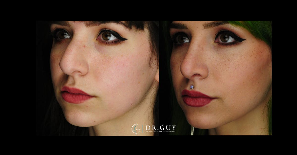 Surgical Rhinoplasty Before & After Gallery - Patient 413816 - Image 1