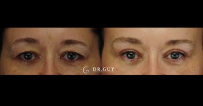 Upper Blepharoplasty Before & After Gallery - Patient 379509 - Image 1