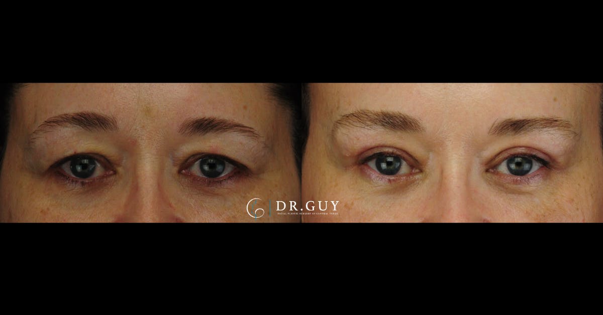 Upper Blepharoplasty Before & After Gallery - Patient 379509 - Image 1