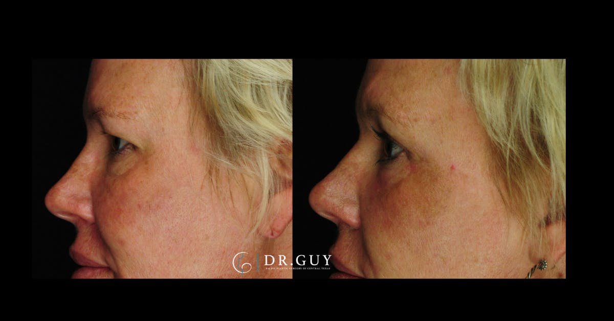 Browlift Before & After Gallery - Patient 755932 - Image 4