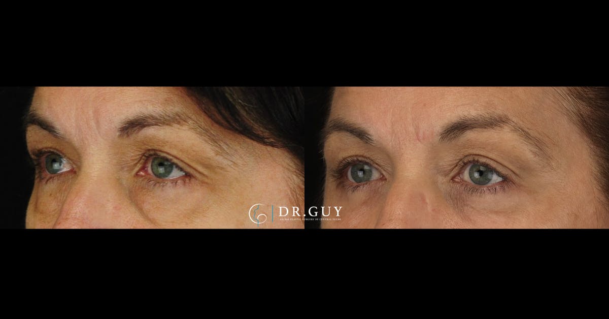 Lower Blepharoplasty Before & After Gallery - Patient 118617 - Image 3