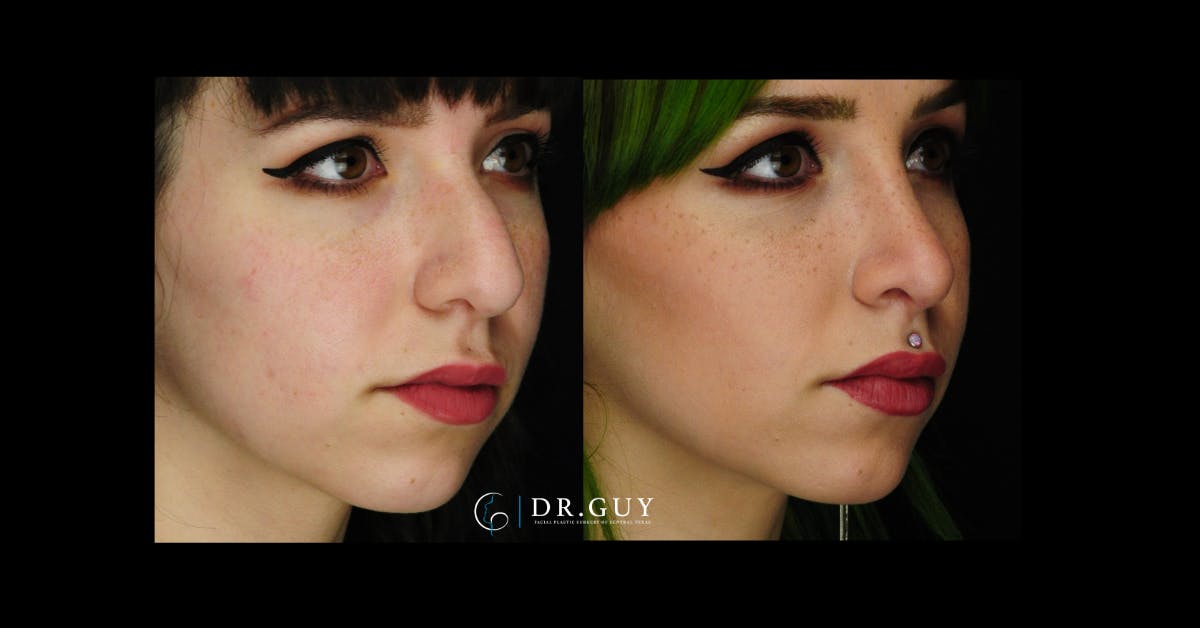 Surgical Rhinoplasty Before & After Gallery - Patient 413816 - Image 2