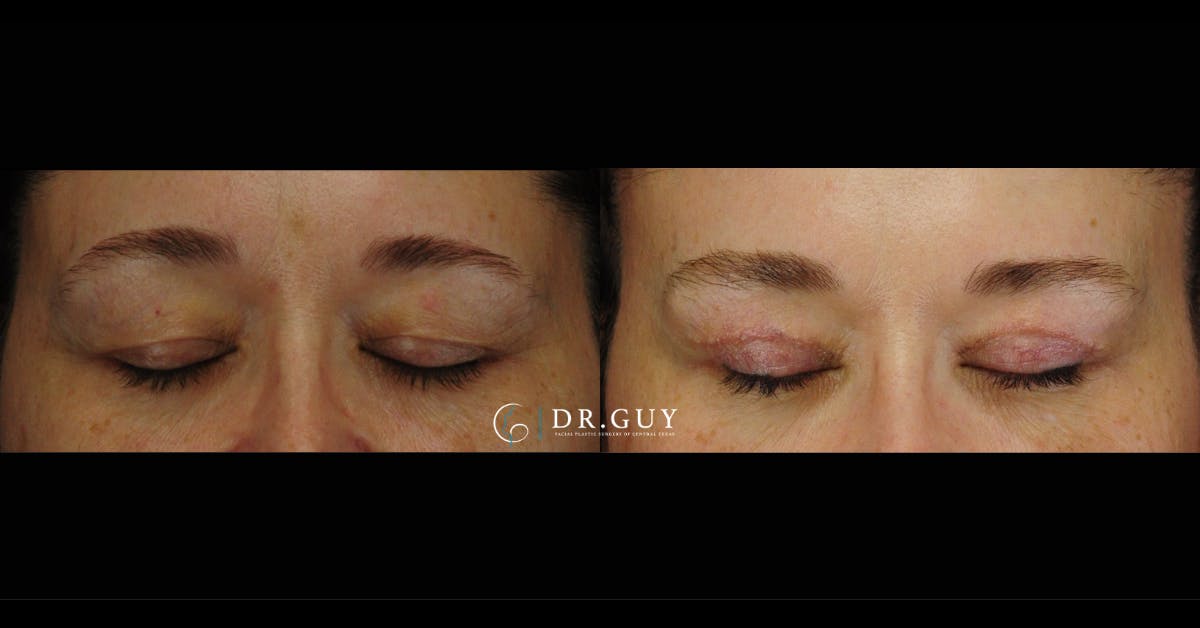 Upper Blepharoplasty Before & After Gallery - Patient 379509 - Image 2