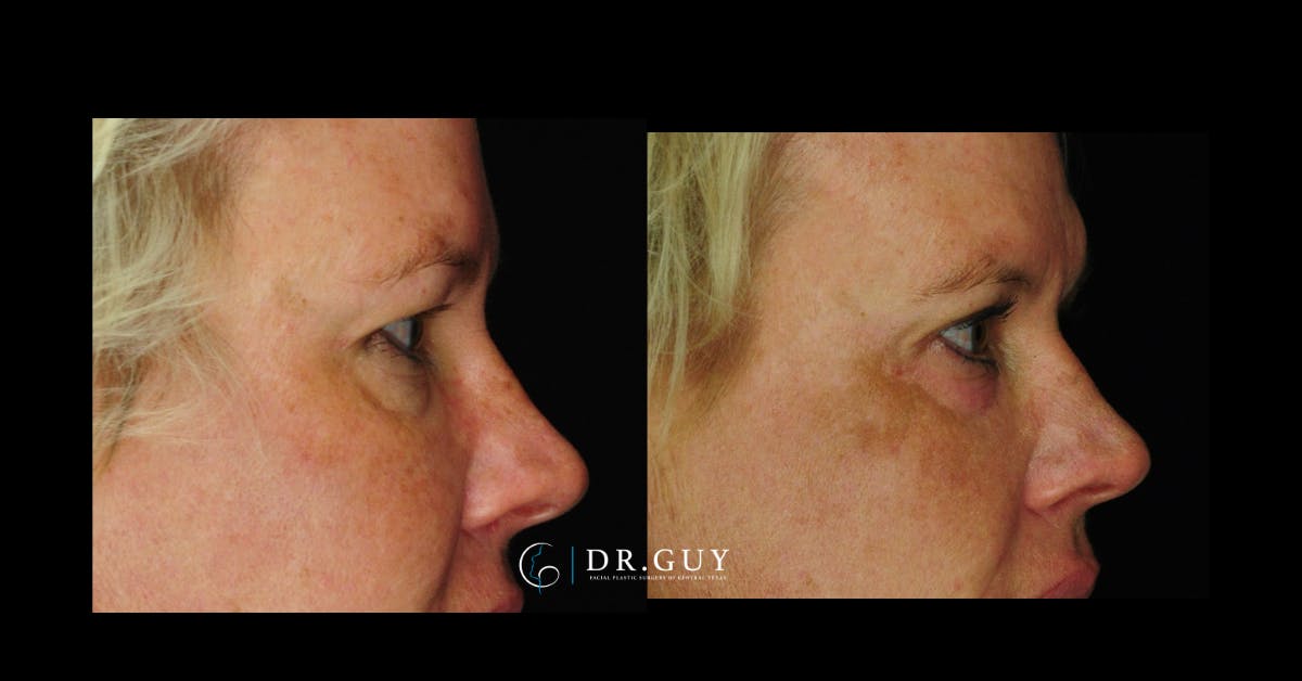 Browlift Before & After Gallery - Patient 755932 - Image 5