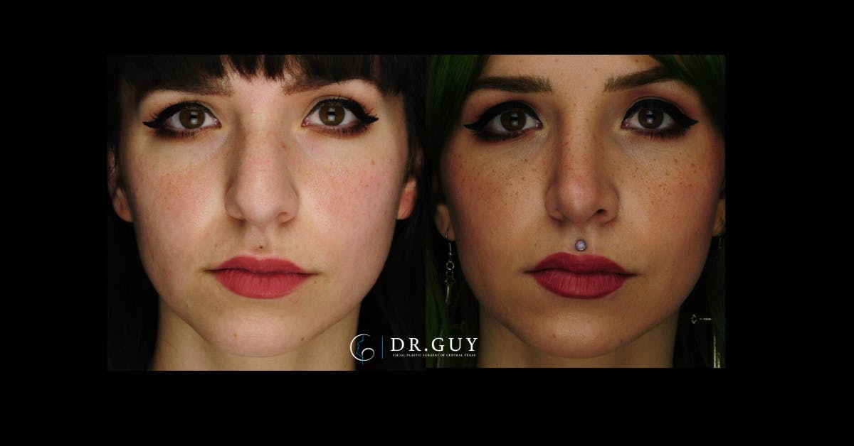 Surgical Rhinoplasty Before & After Gallery - Patient 413816 - Image 3