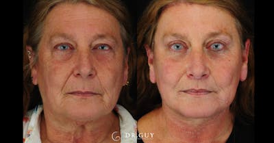 Lower Blepharoplasty Before & After Gallery - Patient 204137 - Image 1