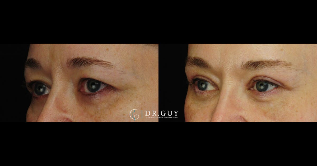 Upper Blepharoplasty Before & After Gallery - Patient 379509 - Image 3