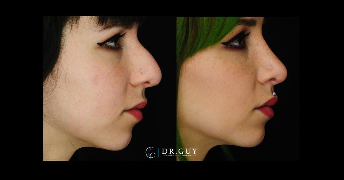 Surgical Rhinoplasty Before & After Gallery - Patient 413816 - Image 4