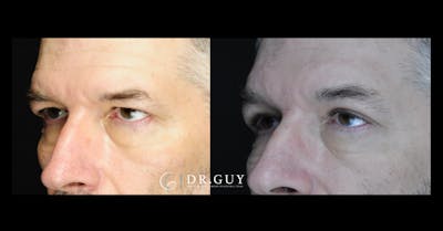 Browlift Before & After Gallery - Patient 400769 - Image 1