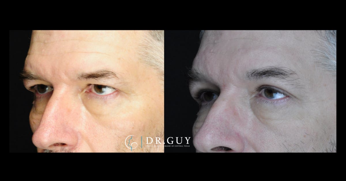 Browlift Before & After Gallery - Patient 400769 - Image 1