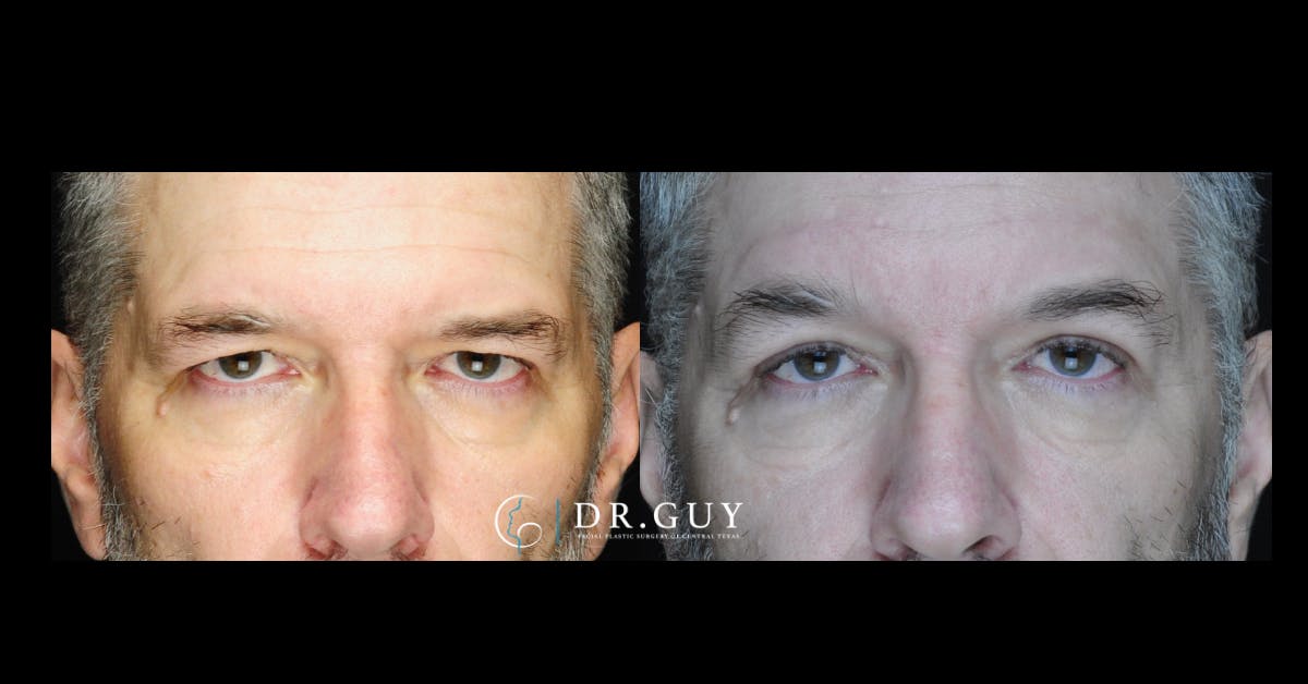 Browlift Before & After Gallery - Patient 400769 - Image 2