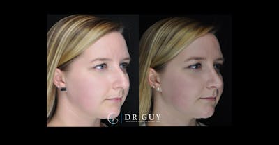 Surgical Rhinoplasty Before & After Gallery - Patient 170208 - Image 1