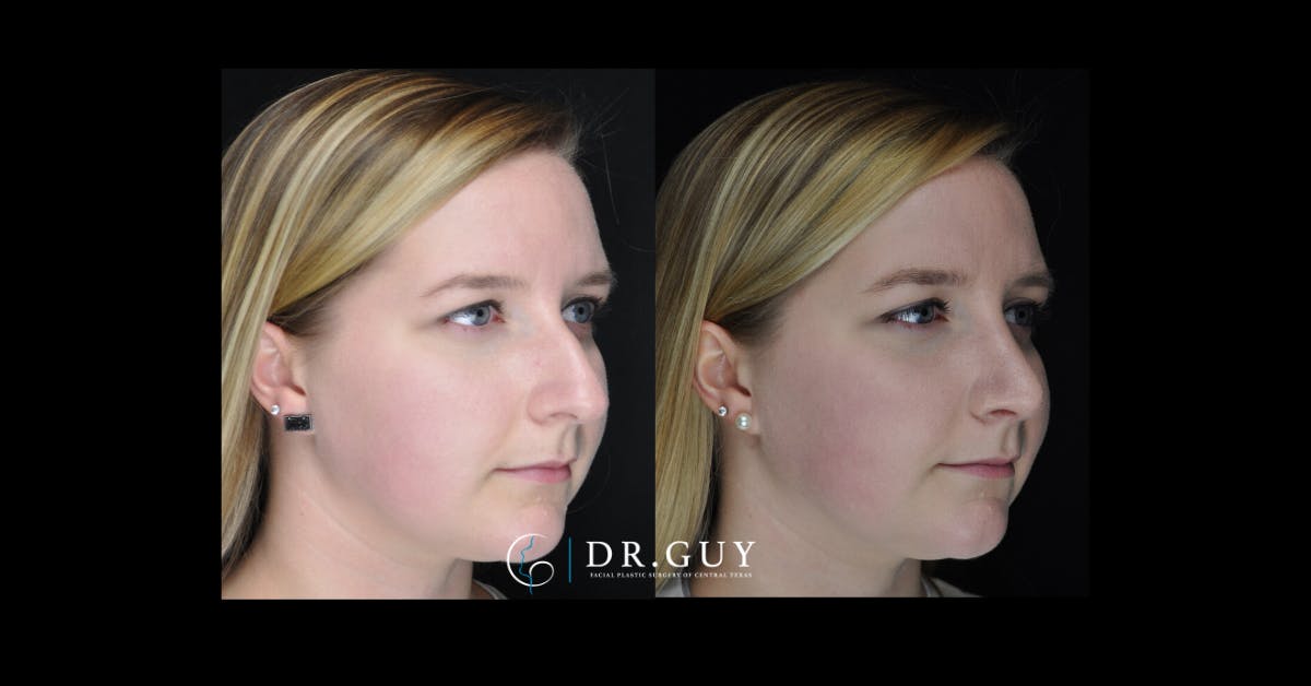 Surgical Rhinoplasty Before & After Gallery - Patient 170208 - Image 1