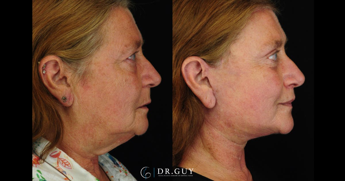 Lower Blepharoplasty Before & After Gallery - Patient 204137 - Image 4