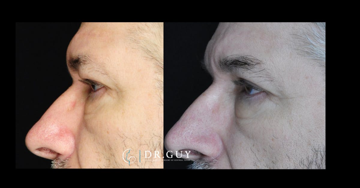 Browlift Before & After Gallery - Patient 400769 - Image 3