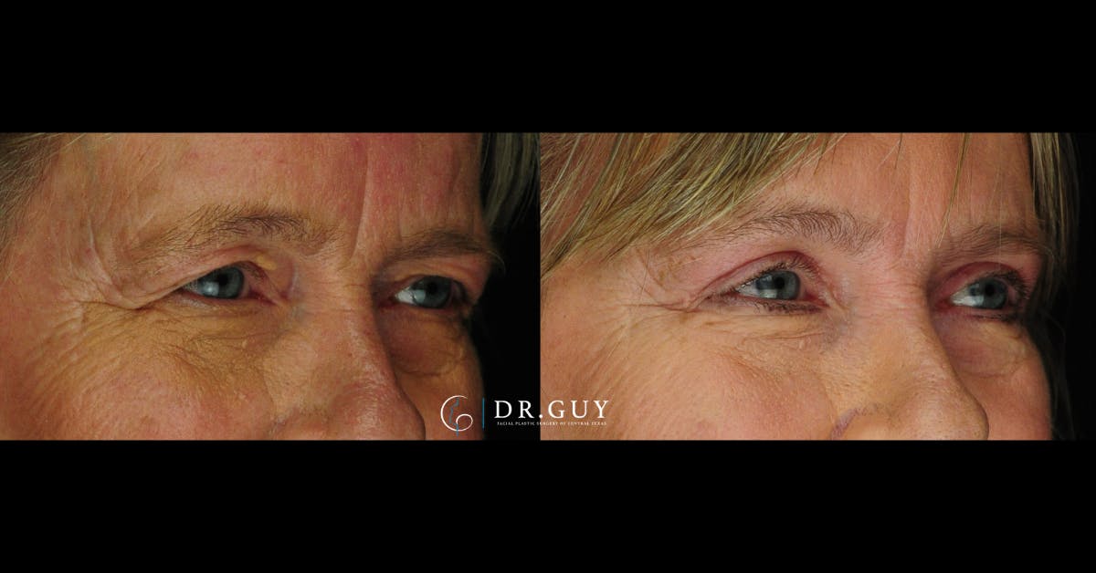 Upper Blepharoplasty Before & After Gallery - Patient 383209 - Image 3