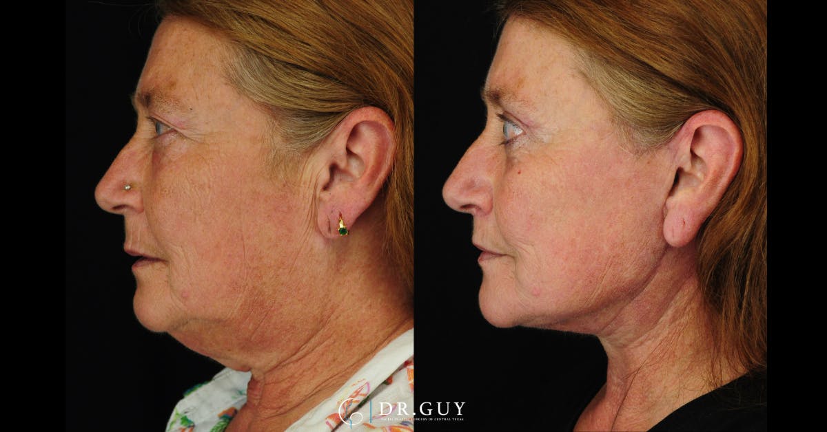 Lower Blepharoplasty Before & After Gallery - Patient 204137 - Image 5