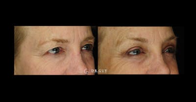 Browlift Before & After Gallery - Patient 170653 - Image 1