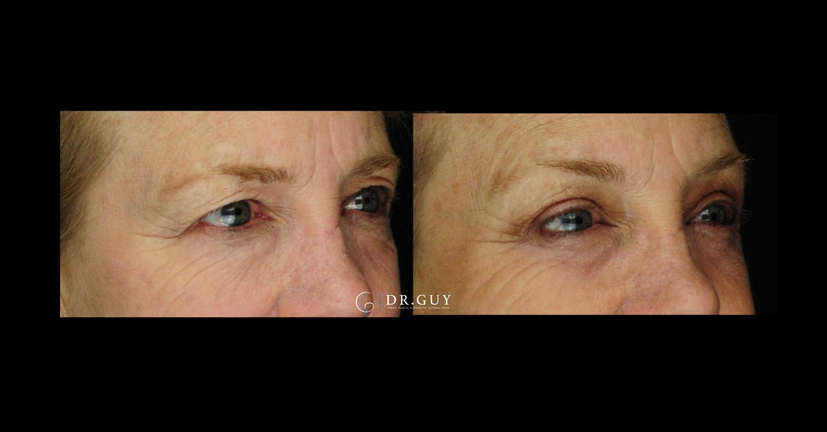 Browlift Before & After Gallery - Patient 170653 - Image 1