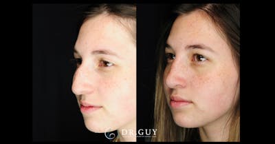 Surgical Rhinoplasty Before & After Gallery - Patient 282257 - Image 1