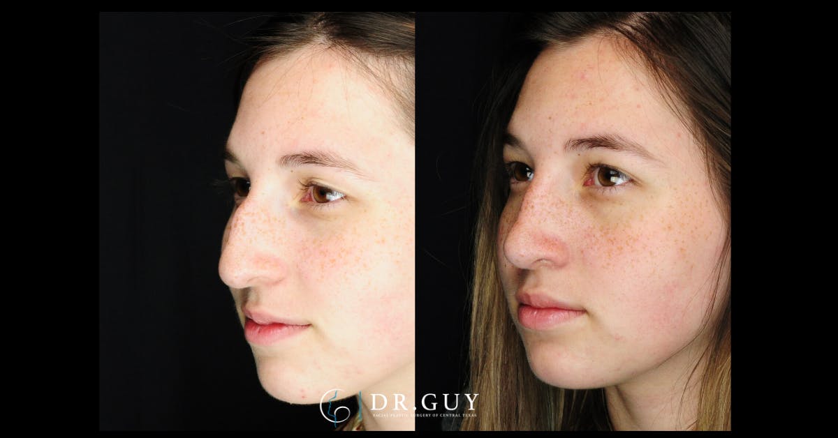Surgical Rhinoplasty Before & After Gallery - Patient 282257 - Image 1